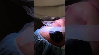 Lasik at Houston Lasik & Eye (Warning: Graphic Content)