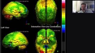 SPECT SCAN OVERVIEW