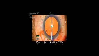 Precision toric guidance system - surgery by Dr Piyush Patil, Yawatmal, India