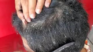 Dandruff Removal At Home | Scratching Dandruff With Comb Part 02