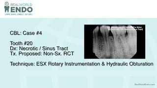 CBL#4: Basic ESX Instrumentation Premolar