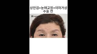 처진눈! 졸린눈! 이마주름! 미간주름! 미루지 말고 누구보다 빨리 젊어지세요! #shorts