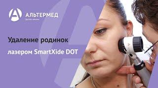 Альтермед. Удаление родинок лазером SmartXide DOT