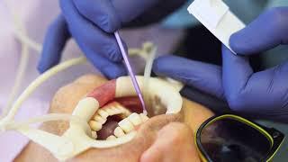 Forever Smiles Orthodontics: Indirect Bonding