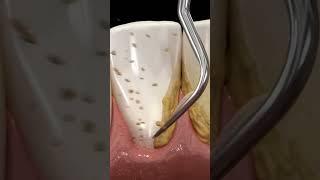 cleaning teeth with ultrasonic scaler #shorts #dentist #teethcleaning