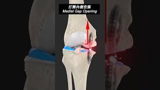 解決O型膝痛  Pain Relief OA Knee