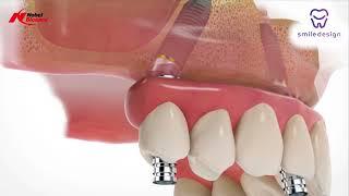 Prótesis Dentales Fijas All On 4 Implantes Dentales