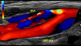 Carotid Artery Dissection Ultrasound