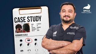 3900 Grafts Hair Transplant Transformation | Dr. Ahmedov's Case Study | 12 Month Results