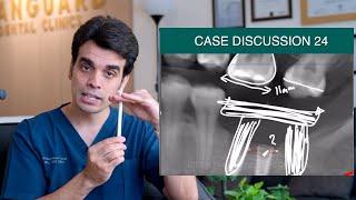 Saving Failing Dental Implants  - Case Discussion 24