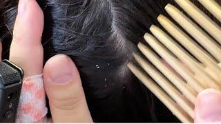 ASMR Dandruff Cleaning: Satisfying Comb & Tweezers Experience for Ultimate Relaxation