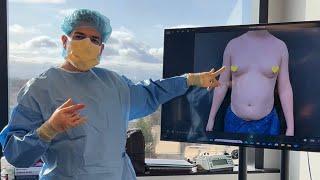 What Does Surgery Day Look Like? | MTF Breast Augmentation | Bamwhat