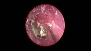 Dry Ear Wax Removal Of The World's Most Dirty Ear - Episode 03