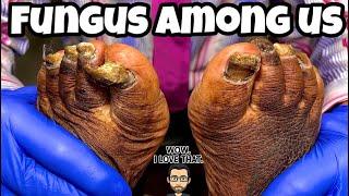 SUPER LARGE FUNGAL TOENAILS (INCREDIBLE TRANSFORMATION)