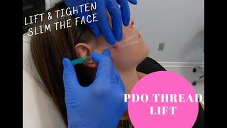 PDO Thread Lift with NOVATHREADS- TIGHTEN FACE AND NECK