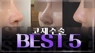 코재수술 BEST 5!  전후사진과 함께 보시죠