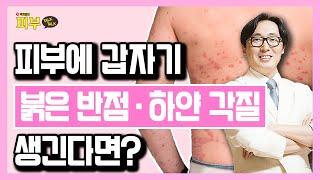 때를 밀거나 안경만 써도 증상 발생? 건선 완치하려면 ‘이것’ 주의하세요! - 박치영의 피부 톡톡 #63