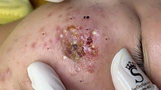 Big Cystic Acne Blackheads Extraction Blackheads & Milia, Whiteheads Removal Pimple Popping # 65562