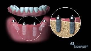 Blue Sky Bio Multi Unit Abutment