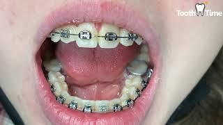 Braces check ups - only changing ligature ties - Tooth Time Family Dentistry New Braunfels