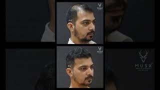 Hair Transplant Result {2024}  - Before and After | Musk Clinic Ahmedabad