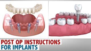 Post op Instructions for Implants