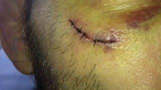 Jon Fitch 20 Days Of A Cut