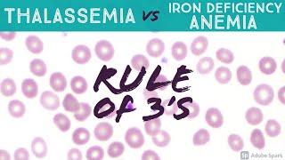 Thalassemia vs Iron Deficiency Anemia (Rule of 3s) Peripheral Blood Smear Hematology Hemepath Basics