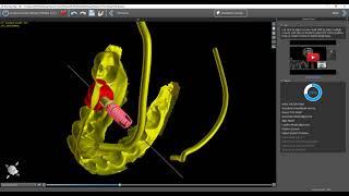 BSP4.9 - Step by Step Implant Planning Wizard