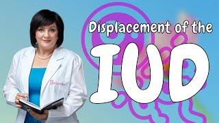 How to determine the displacement of the IUD  #doctorberezovska #iud #womenshealth #olenaberezovska