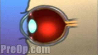 Laser Eye Lasik Surgery PreOp® Patient Engagement and Education