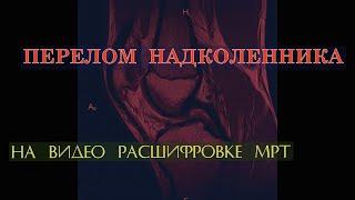 ПЕРЕЛОМ НАДКОЛЕННИКА с формированием ЛОЖНОГО СУСТАВА на ВИДЕО РАСШИФРОВКЕ МРТ коленного сустава