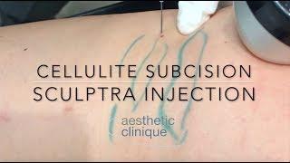 Cellulite Subcision Sculptra Injection done with Blunt Cannulas by Dr. Steven F. Weiner