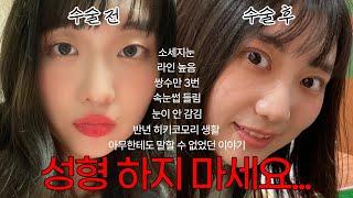 쌍수 망하고 히키코모리 된 이야기... | 예쁜 눈진격의 거인 닮은 꼴 됨 | 눈 안 감김, 점막 들림, 소세지눈, 라인 높음 | 성형 부작용 ssul