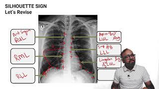 SPOTTERZ - 04 - CXR - Lobar consolidation