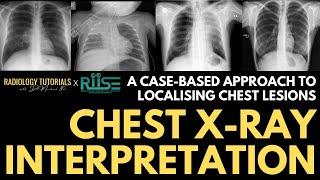 Localising Lesions on Chest Radiographs | A Case-Based Approach | RIISE Workshop