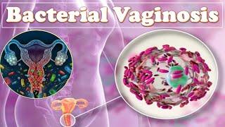 Bacterial Vaginosis (Vaginal Infection) : Causes, Signs & Symptoms, Diagnosis and Treatment