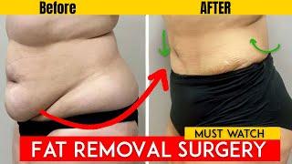 Fat Removal by Liposuction Explained: Procedure, Benefits, Risks, Cost & Recovery | Dr. Vikas Gawri