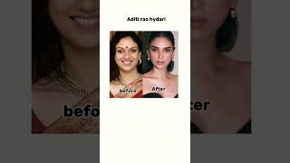 bollywood actress before plastic surgery and after #priyanka#anushkasharma#bollywood #shorts