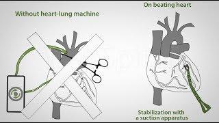 Coronary artery bypass on a beating heart