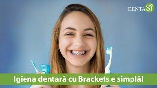 Igiena dentară cu Brackets e simplă!