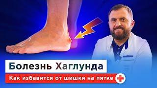 О чем говорит боль в пятке? Деформация Хаглунда-Шинца: причины, симптомы, бесплатное лечение по ОМС