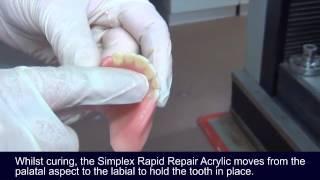 Using Simplex Rapid Acrylic to repair a denture