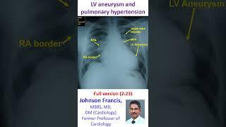 Left ventricular aneurysm and pulmonary hypertension