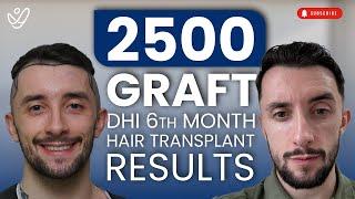 2500 Graft DHI: 6-Month Hair Transplant Before and After