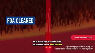 iRestore Elite: FDA-Cleared Laser Hair Growth System for Thicker Hair
