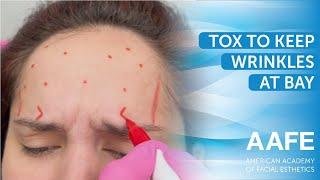 Tox to Keep Wrinkles at Bay