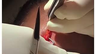 Forehead Lipoma Removal!