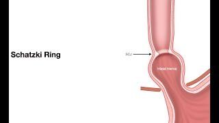 ECE-Lesson 2f5-Pathology of Esophagus-Schatzki ring