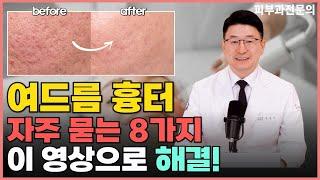 피부과 전문의가 여드름 흉터 없애는 법 알려드립니다! 여드름 흉터에 대한 궁금한 8가지 해결!